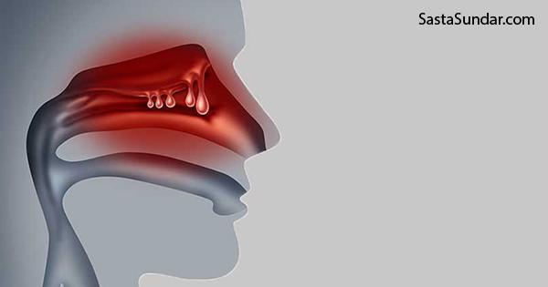 Nasal Polyps