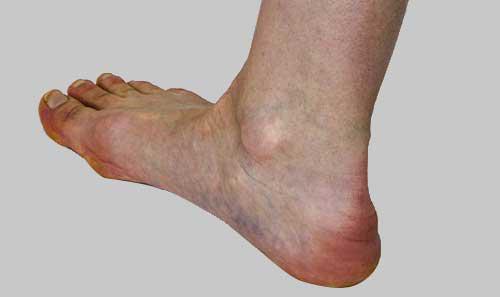 Cheap 10/20 Pcs Heel Spur Pain Relief Patch Herbal Bone Spurs Achilles  Tendonitis Patch Calcaneal Spur Plaster Foot Care Tool | Joom